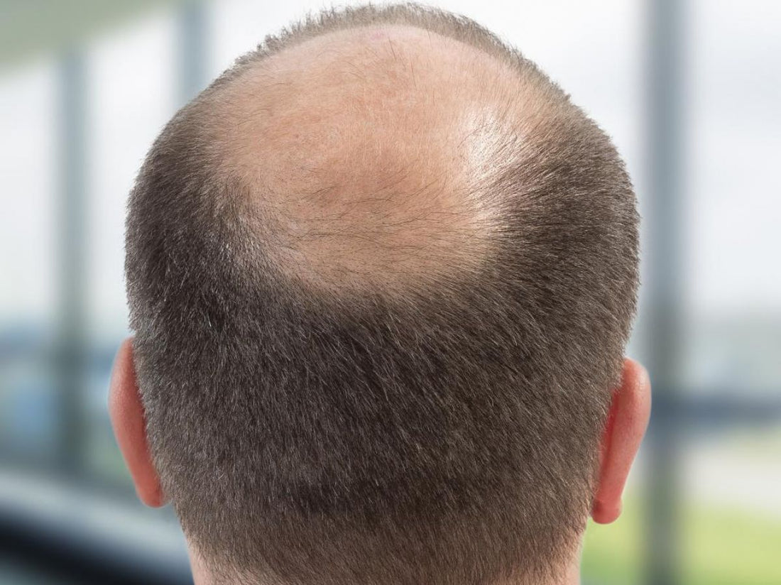 Calvitie : origine, évolution et solutions pour mieux vivre la perte de cheveux