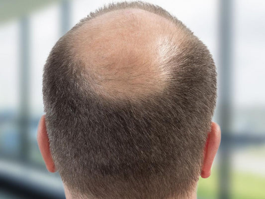 Calvitie : origine, évolution et solutions pour mieux vivre la perte de cheveux